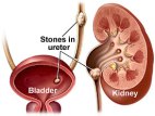 kidney-stones1
